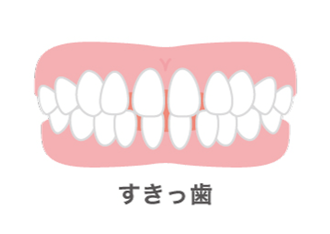 すきっ歯の症例