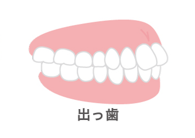 出っ歯の症例