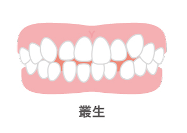 歯のがたつきの症例